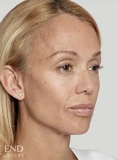 Sculptra Before & After