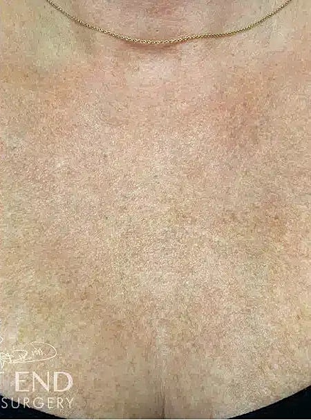 Sculptra Before & After