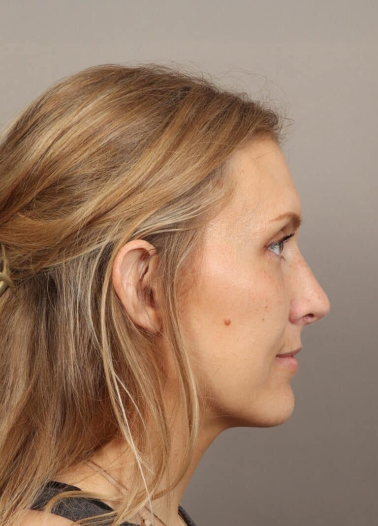 Nose Job Rhinoplasty Before & After