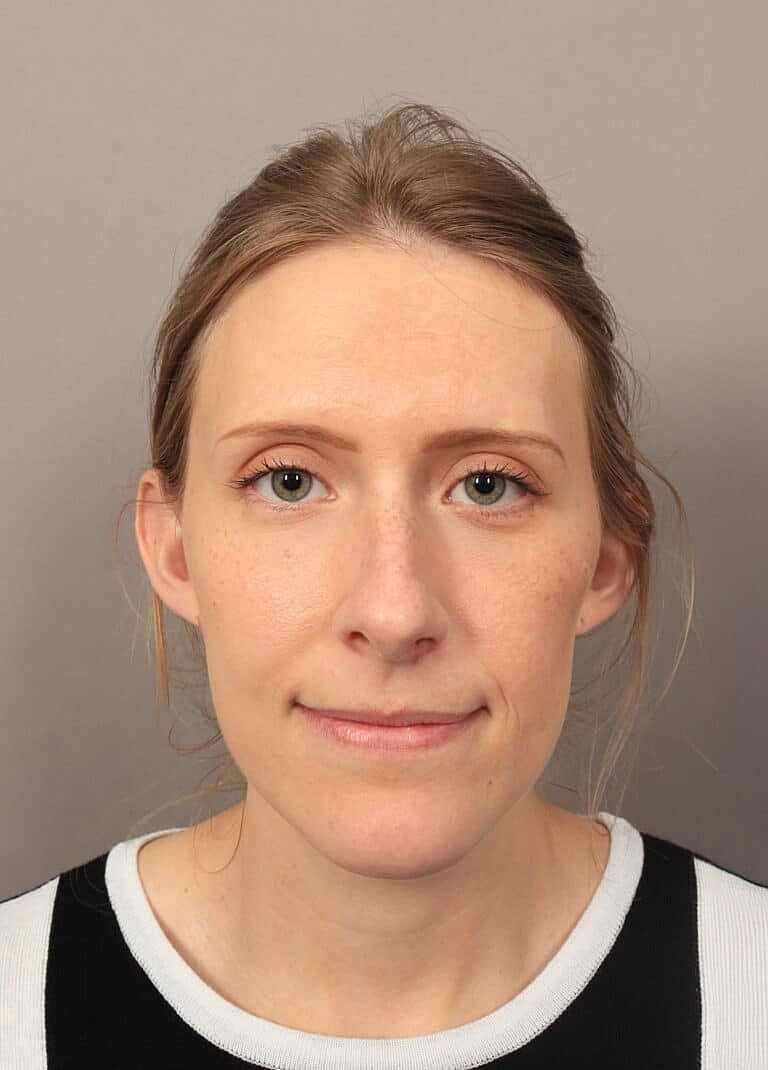 Nose Job Rhinoplasty Before & After