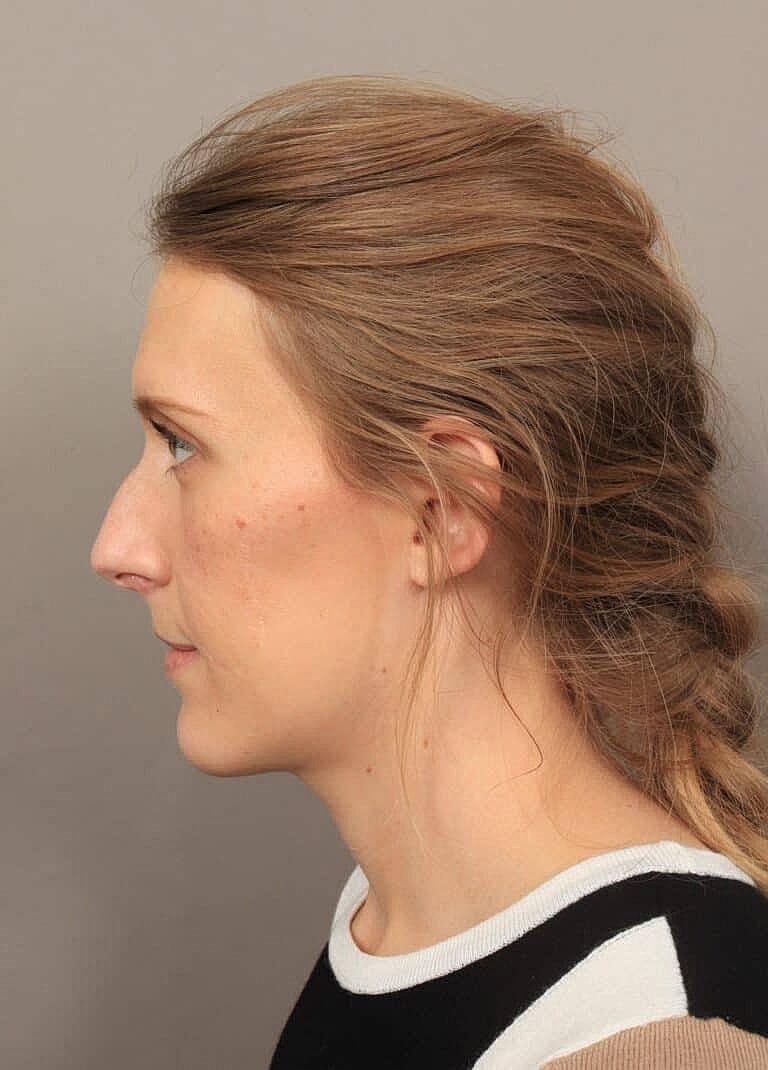 Nose Job Rhinoplasty Before & After