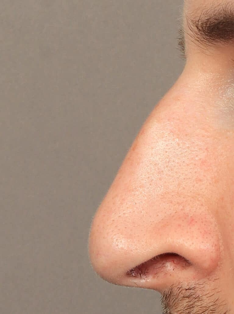 Nose Job Rhinoplasty Before & After