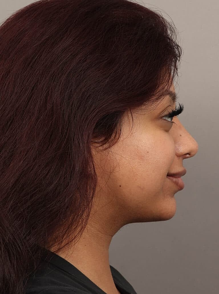 Nose Job Rhinoplasty Before & After