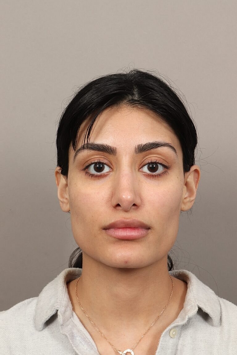 Nose Job Rhinoplasty Before & After