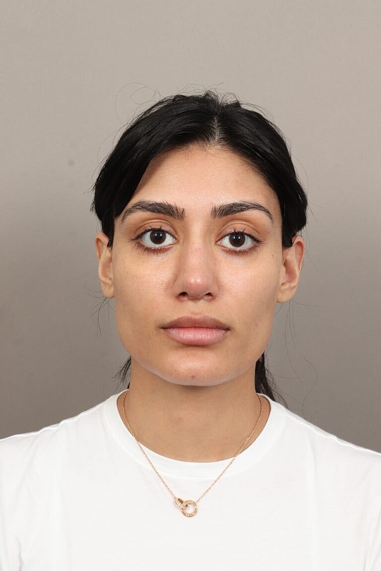 Nose Job Rhinoplasty Before & After