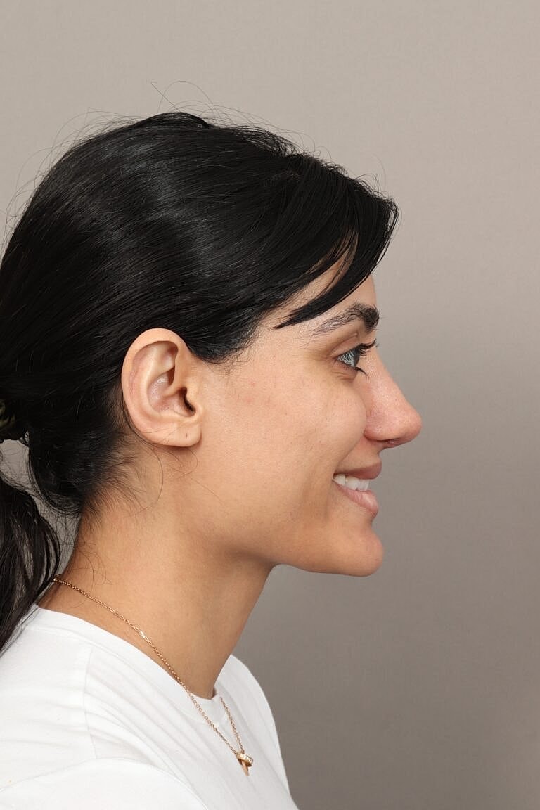 Nose Job Rhinoplasty Before & After