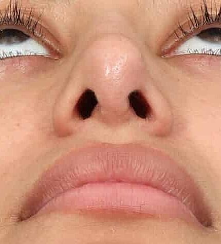 Nose Job Rhinoplasty Before & After