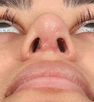 Nose Job Rhinoplasty Before & After