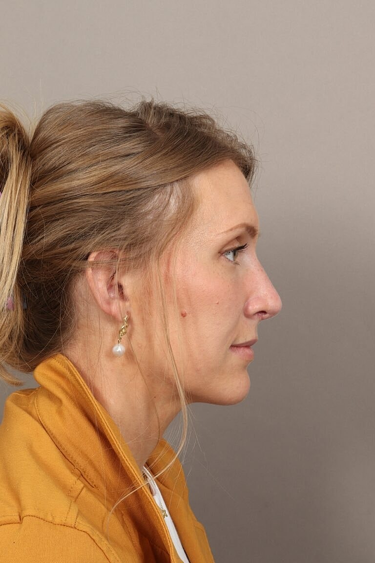 Nose Job Rhinoplasty Before & After