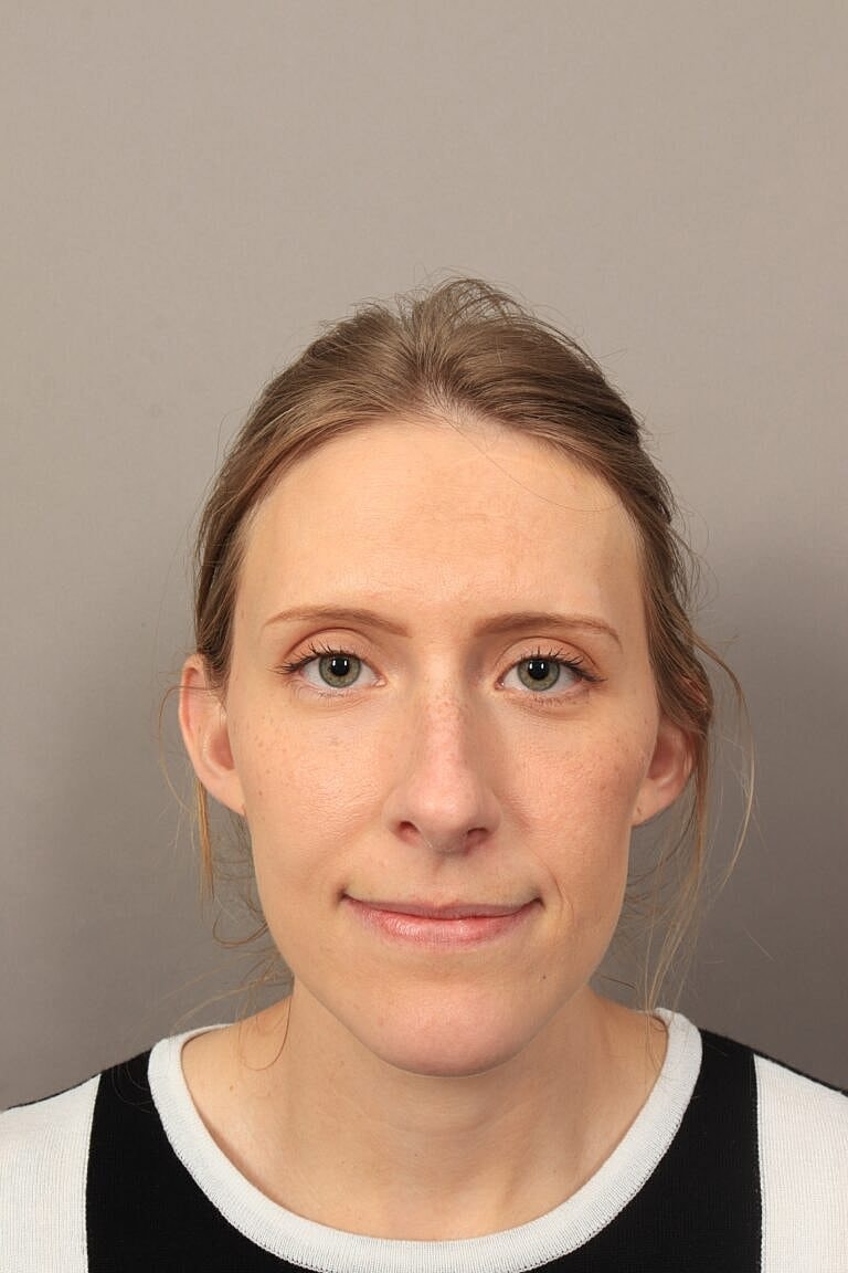 Nose Job Rhinoplasty Before & After