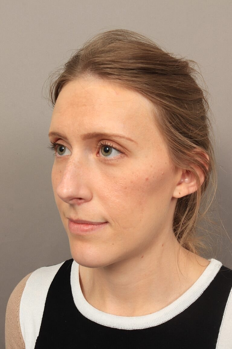 Nose Job Rhinoplasty Before & After