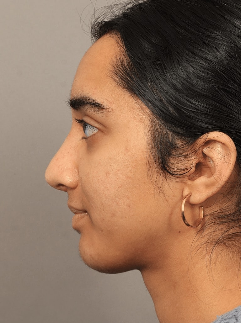 Nose Job Rhinoplasty Before & After