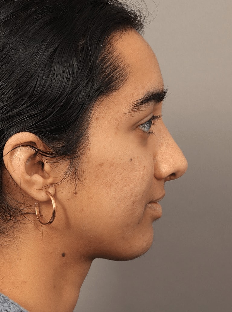 Nose Job Rhinoplasty Before & After