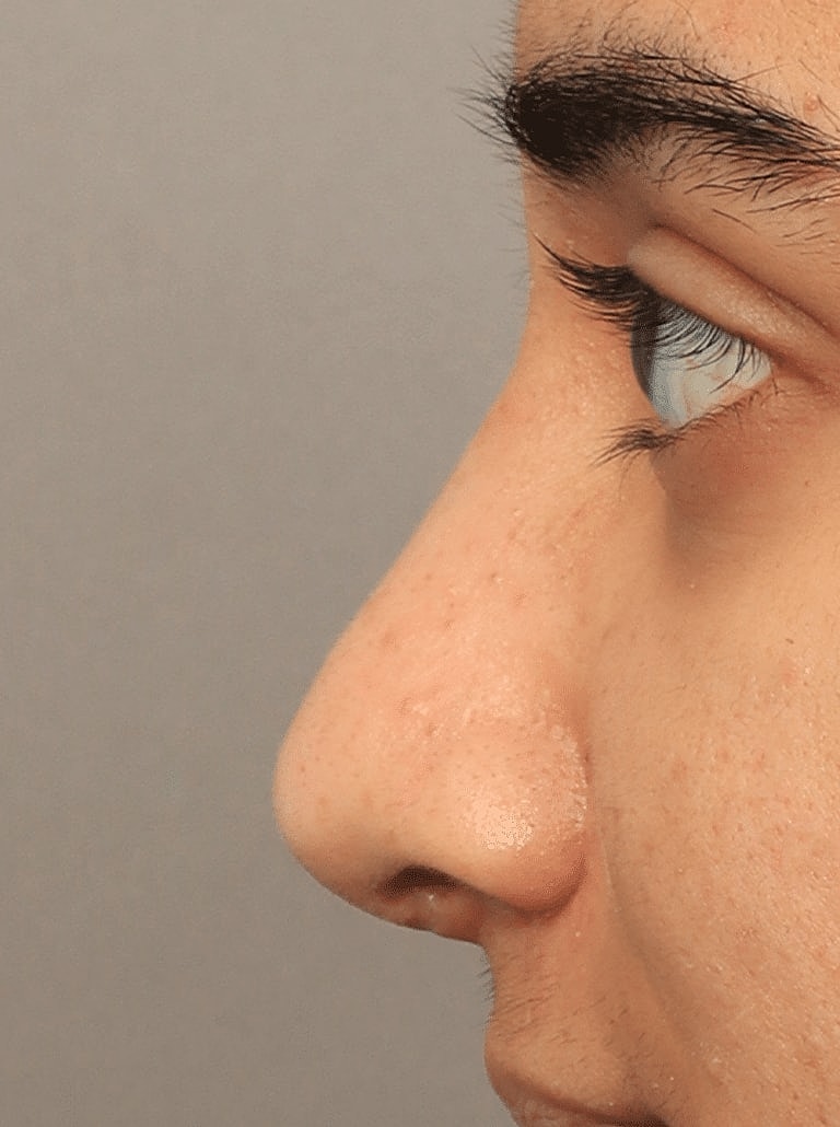 Nose Job Rhinoplasty Before & After