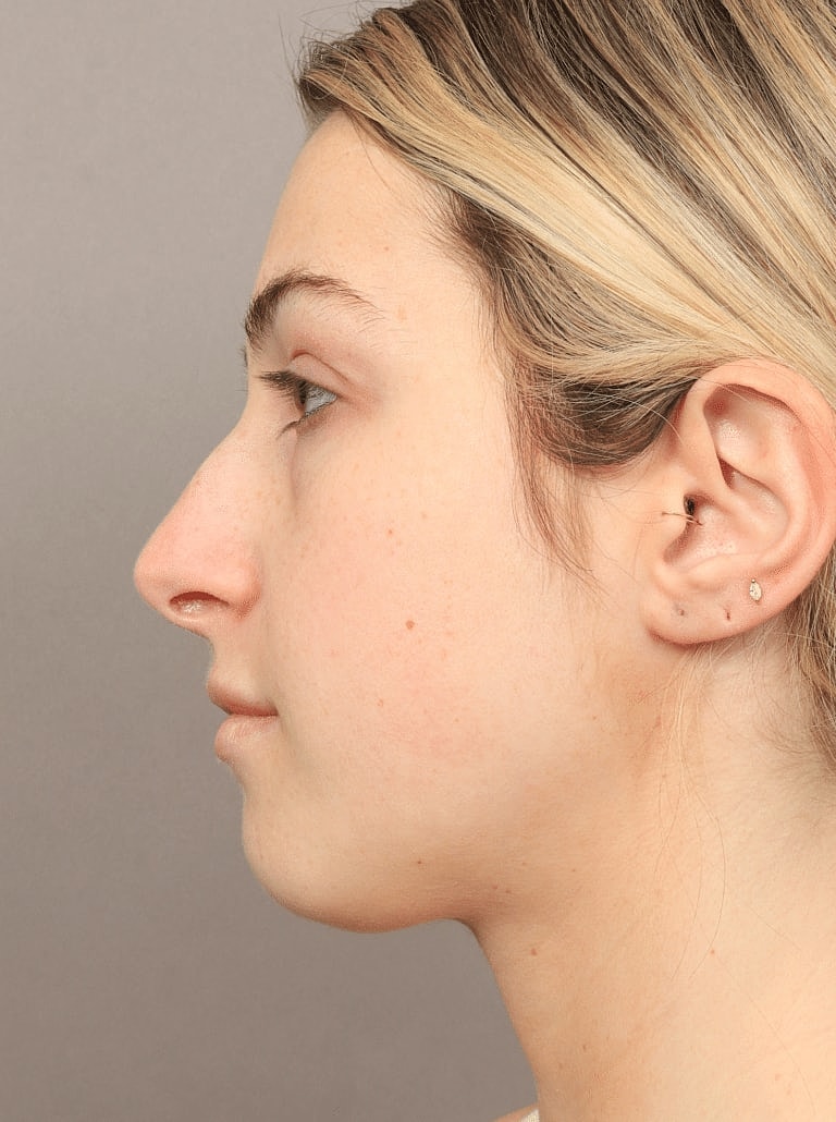 Nose Job Rhinoplasty Before & After