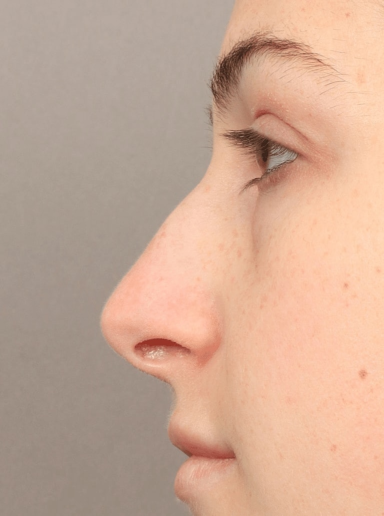 Nose Job Rhinoplasty Before & After