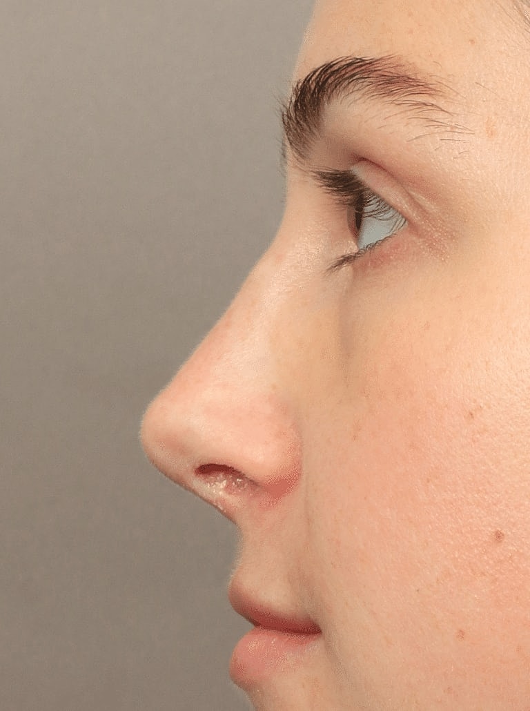 Nose Job Rhinoplasty Before & After