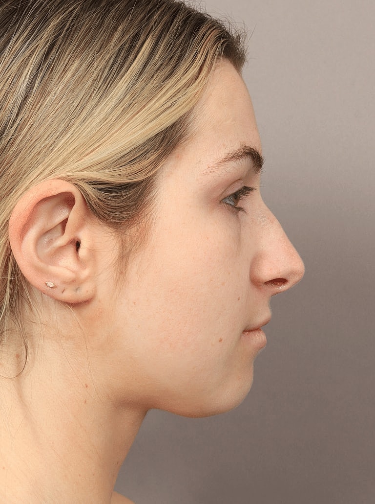 Nose Job Rhinoplasty Before & After
