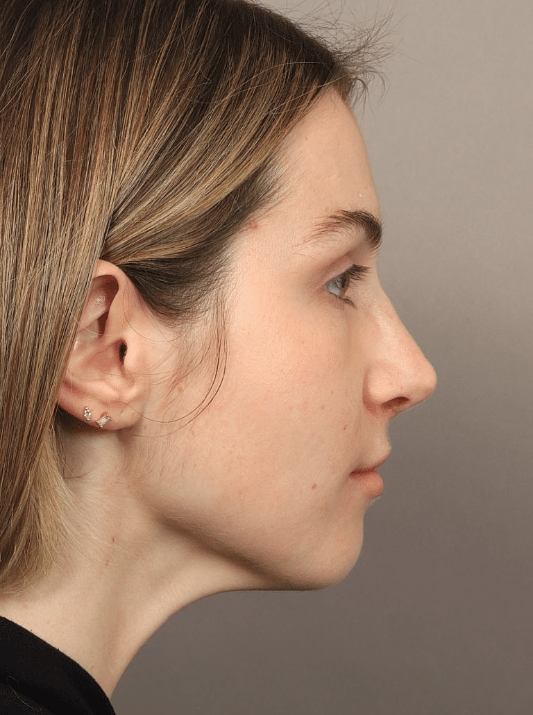 Nose Job Rhinoplasty Before & After