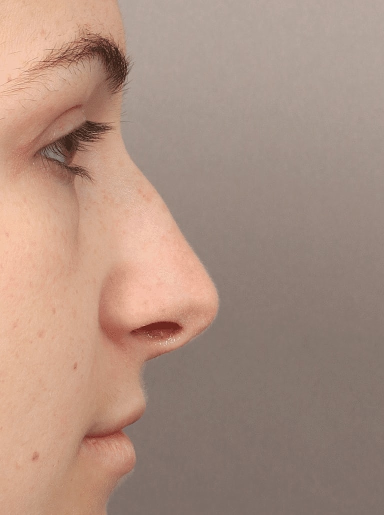 Nose Job Rhinoplasty Before & After