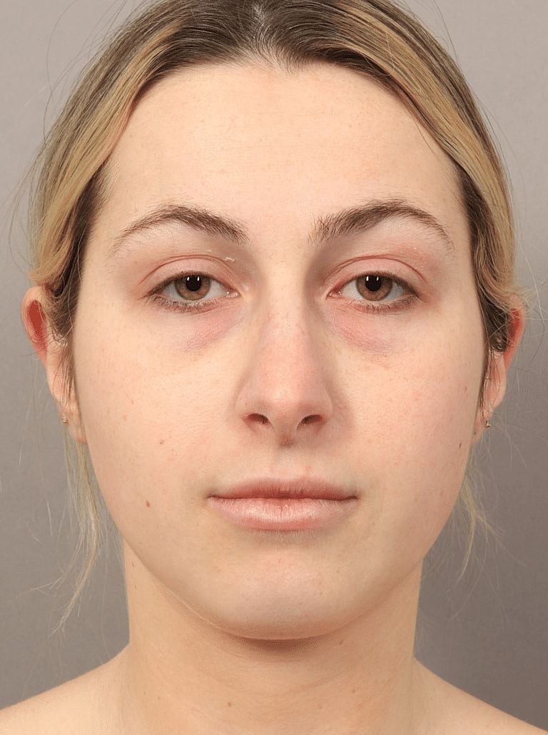 Nose Job Rhinoplasty Before & After