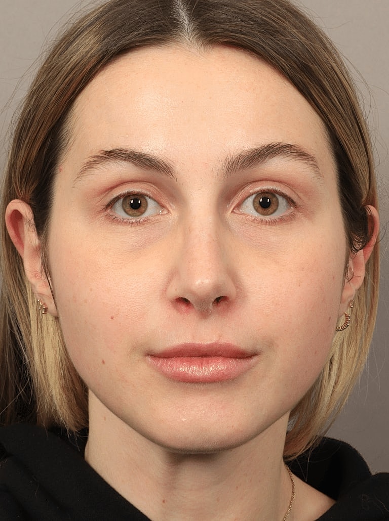 Nose Job Rhinoplasty Before & After