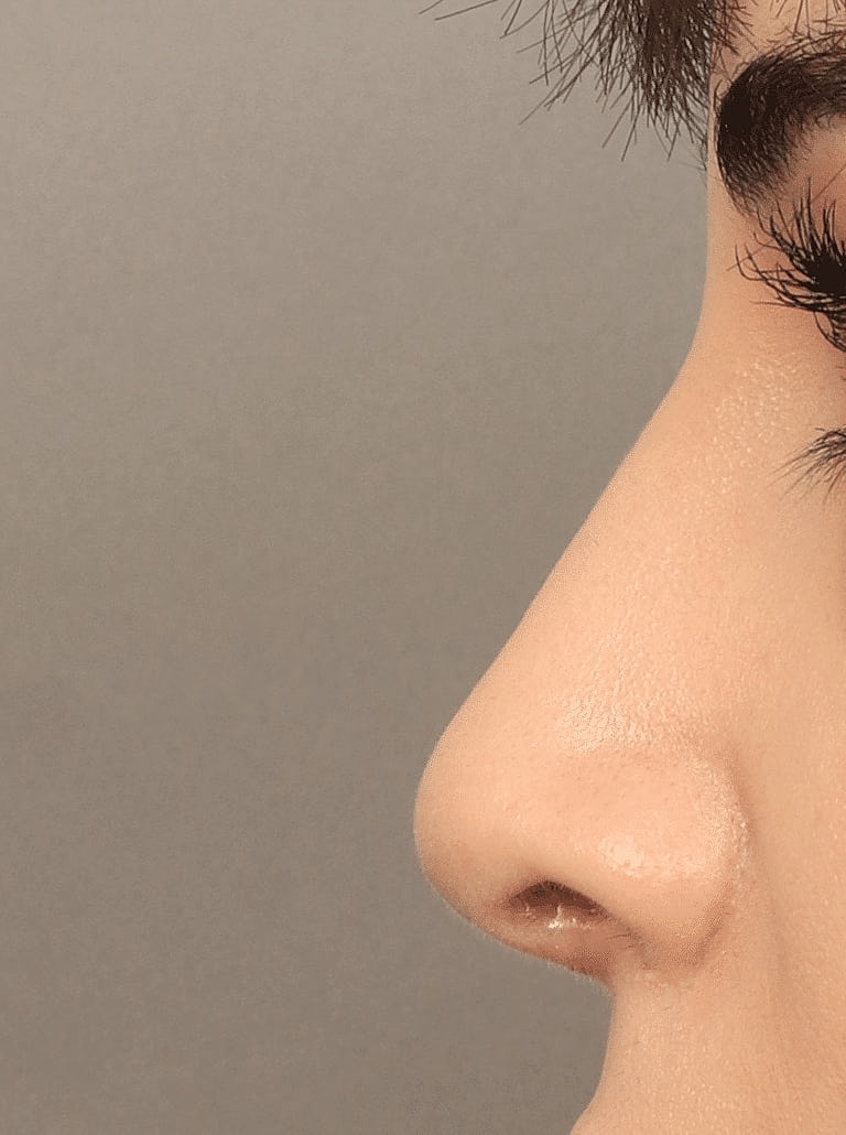 Nose Job Rhinoplasty Before & After