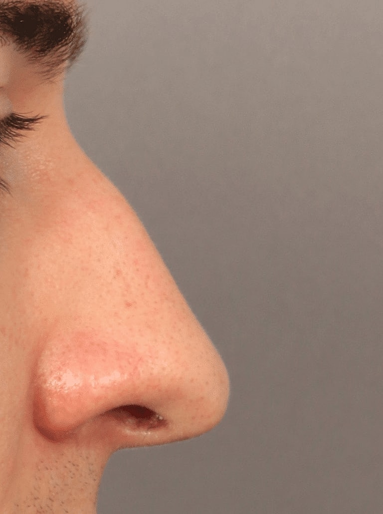 Nose Job Rhinoplasty Before & After