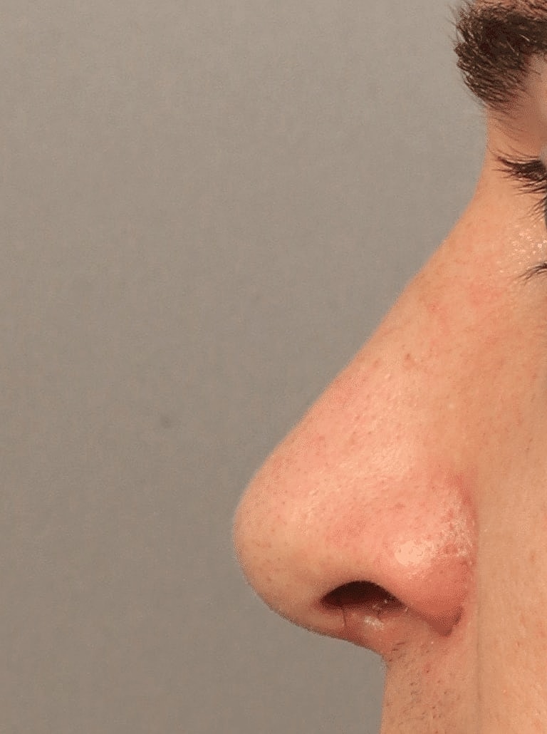 Nose Job Rhinoplasty Before & After