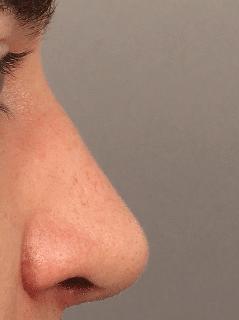 Nose Job Rhinoplasty Before & After