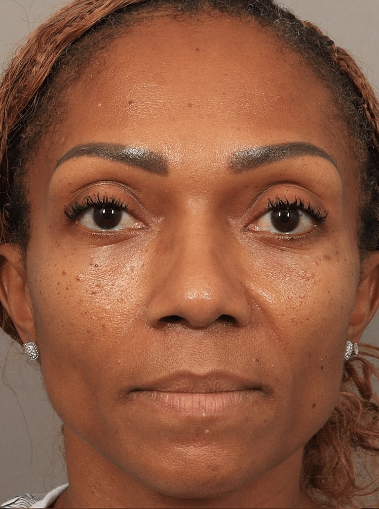 Nose Job Rhinoplasty Before & After