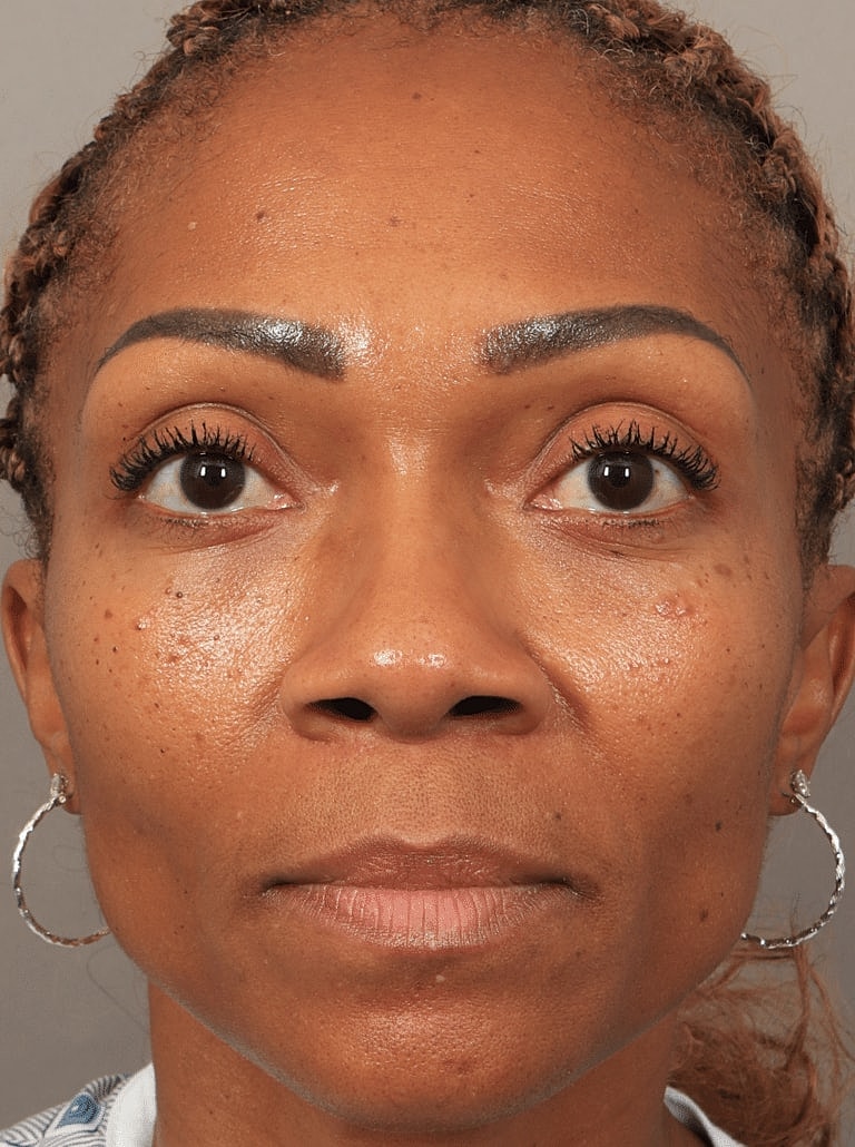 Nose Job Rhinoplasty Before & After