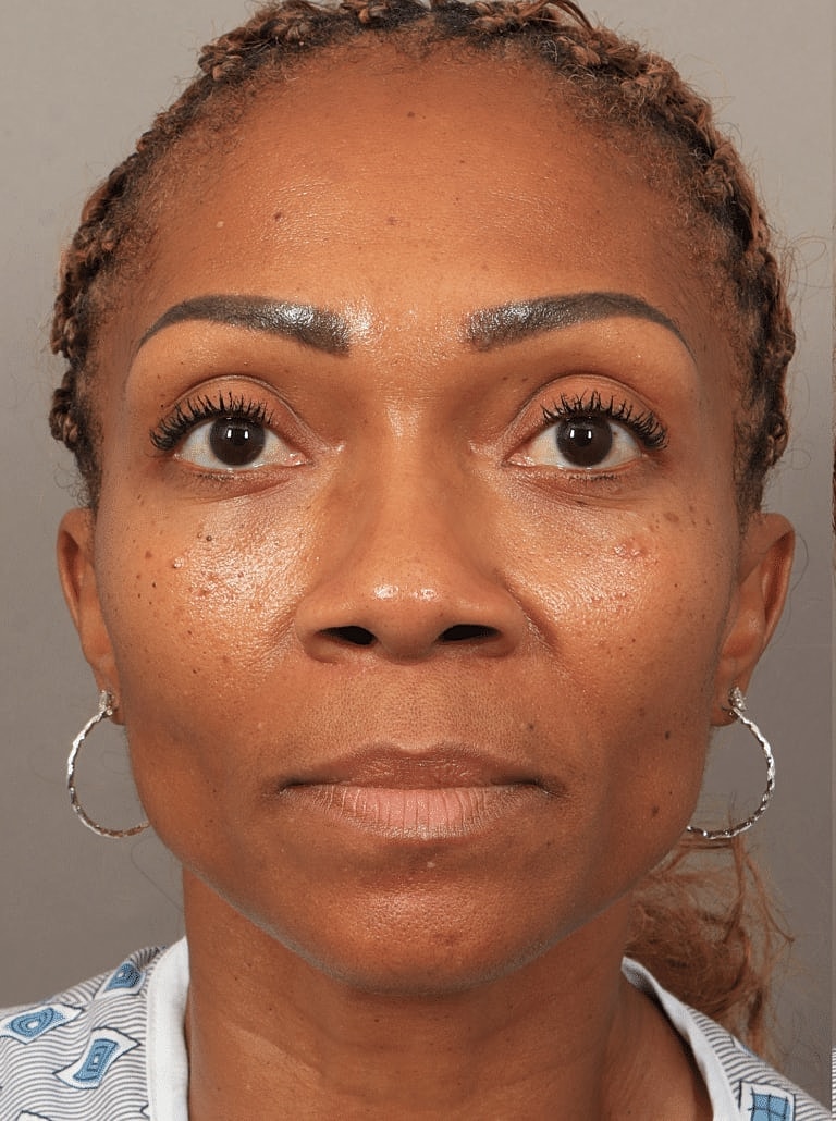 Nose Job Rhinoplasty Before & After