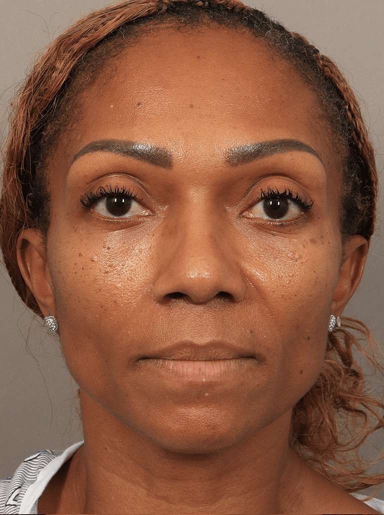 Nose Job Rhinoplasty Before & After