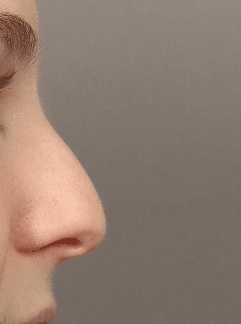 Nose Job Rhinoplasty Before & After