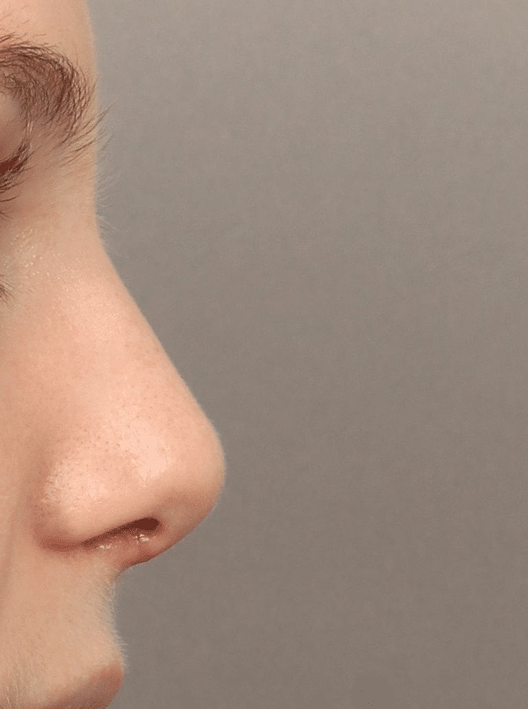 Nose Job Rhinoplasty Before & After