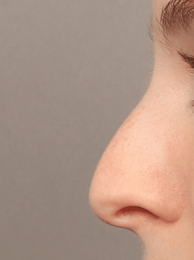 Nose Job Rhinoplasty Before & After