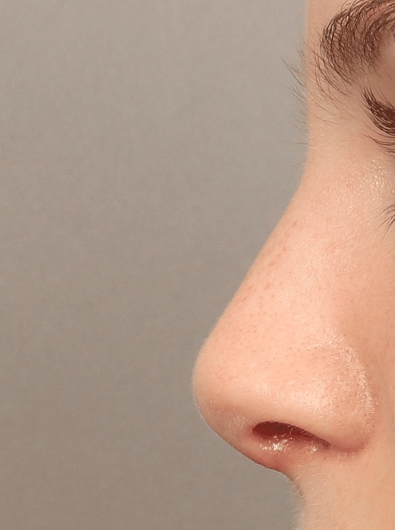 Nose Job Rhinoplasty Before & After