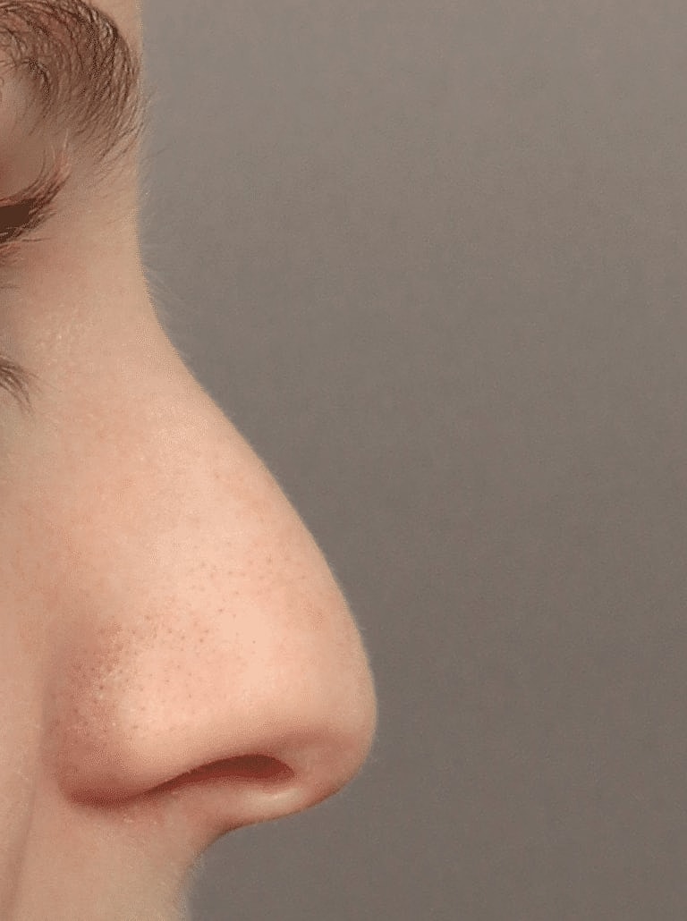 Nose Job Rhinoplasty Before & After