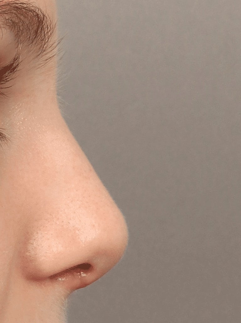 Nose Job Rhinoplasty Before & After