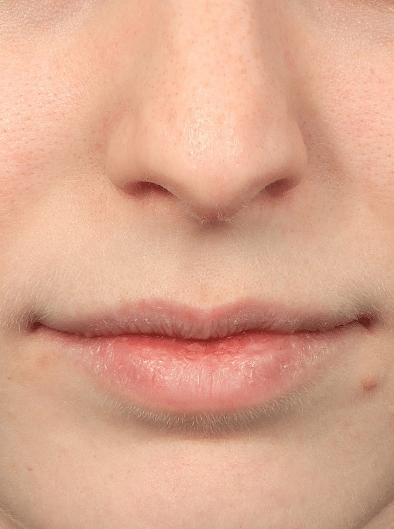 Nose Job Rhinoplasty Before & After