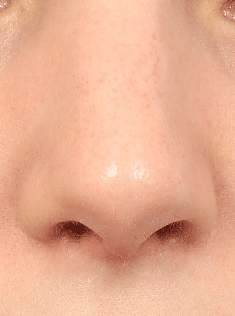 Nose Job Rhinoplasty Before & After