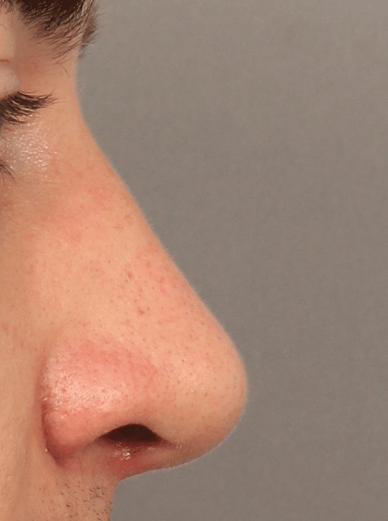 Nose Job Rhinoplasty Before & After