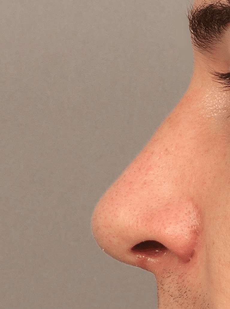 Nose Job Rhinoplasty Before & After