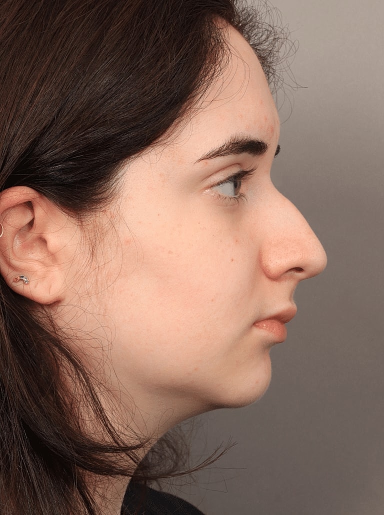 Nose Job Rhinoplasty Before & After