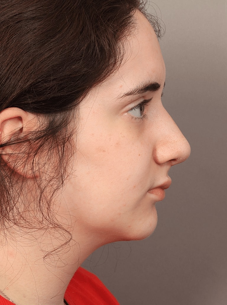 Nose Job Rhinoplasty Before & After