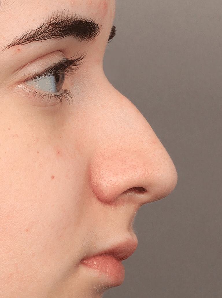 Nose Job Rhinoplasty Before & After