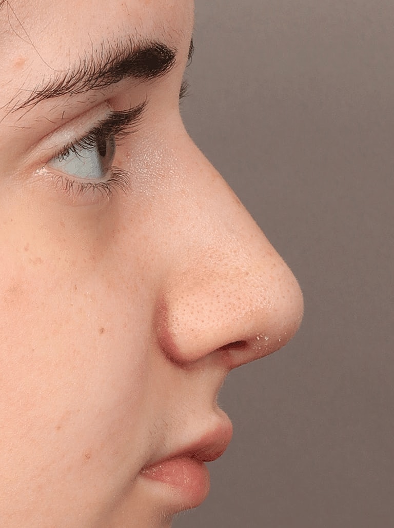 Nose Job Rhinoplasty Before & After