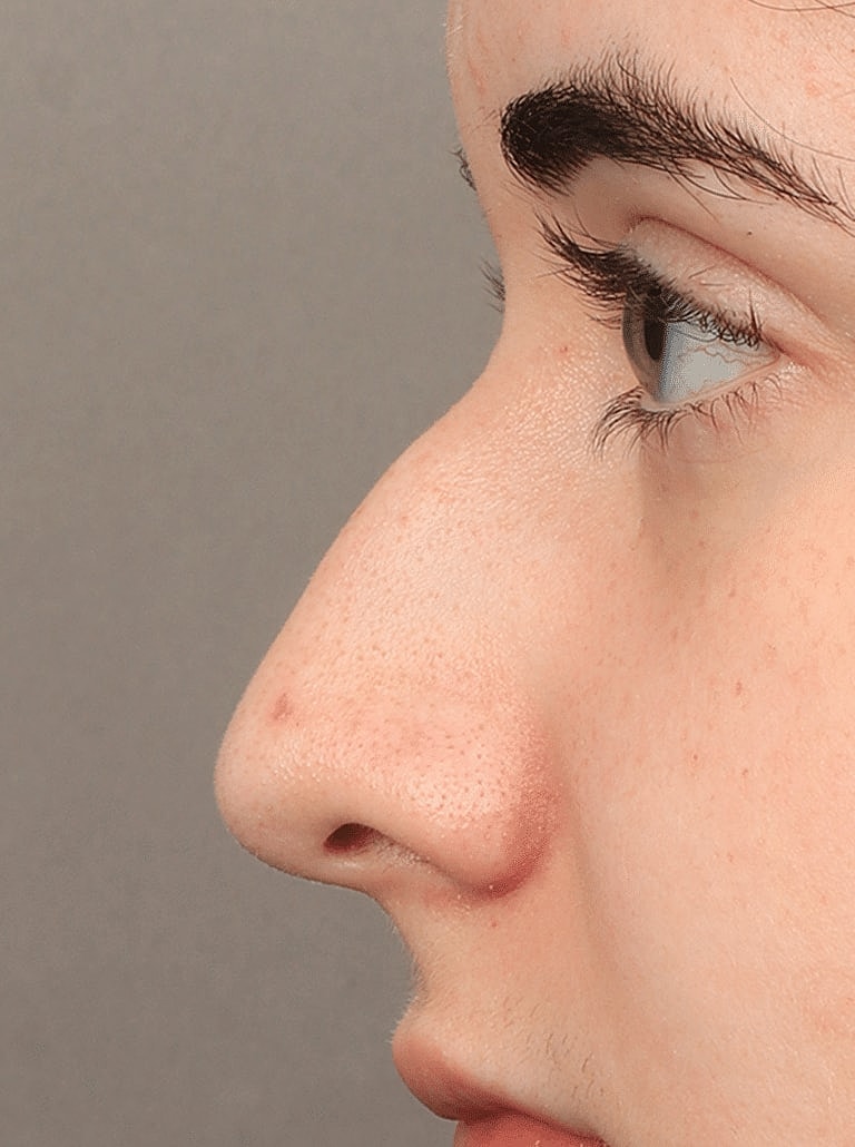 Nose Job Rhinoplasty Before & After