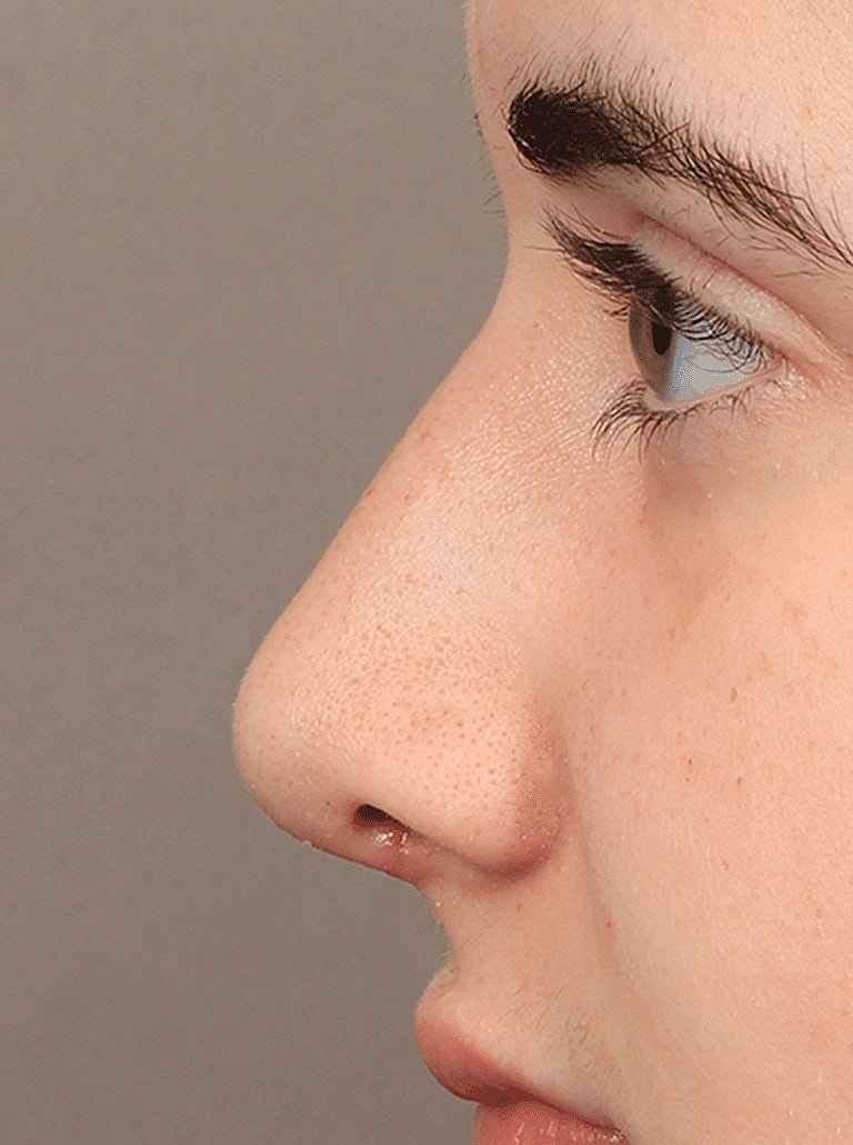 Nose Job Rhinoplasty Before & After